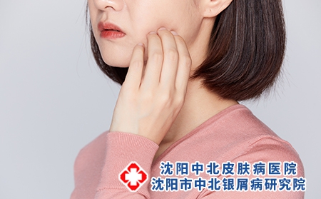 女性面部银屑病能做美容吗？