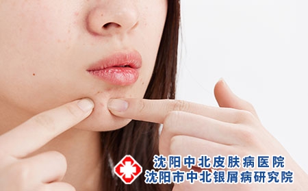 哪些因素与沈阳牛皮癣之间有联系