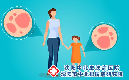 脓包型银屑病患病因素有哪些