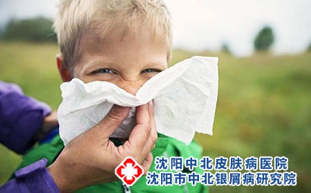 为什么牛皮癣会在冷天加重?