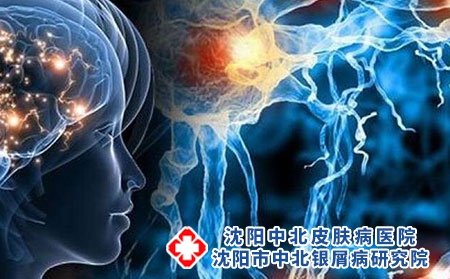 沈阳中北银屑病医院：关于银屑病患者用激素的疑问有哪些?