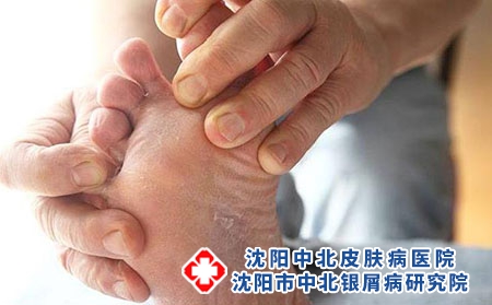 各类型牛皮癣应该如何判断？