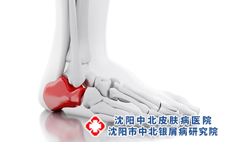 摄图网_303363041_3d说明白色背景上疼痛的脚踝医学概念（企业商用）