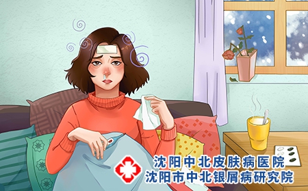 银屑病总是季节交替的发作怎么办?