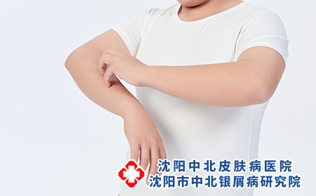 青少年银屑病该如何正确治疗？