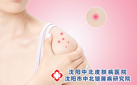红皮型银屑病的皮损特征