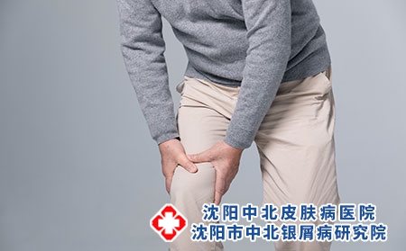 牛皮癣性关节炎，你知道多少? 牛皮癣性关节炎的护理