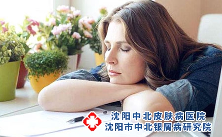 牛皮癣的遗传率高吗 牛皮癣的治疗方法