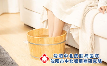 泡脚对牛皮癣的治疗有什么好处呢？