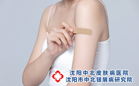 银屑病患处受伤怎么办？
