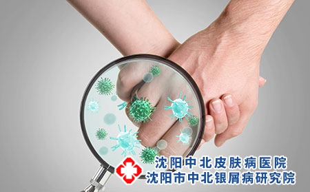 得了牛皮癣可传染吗 牛皮癣到底要怎样治疗