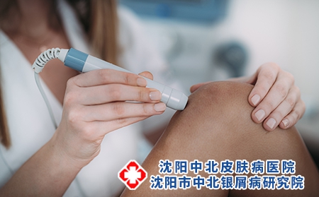 寻常型银屑病能治愈吗?