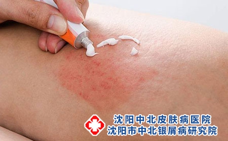 什么是红皮病型牛皮癣 有何表现