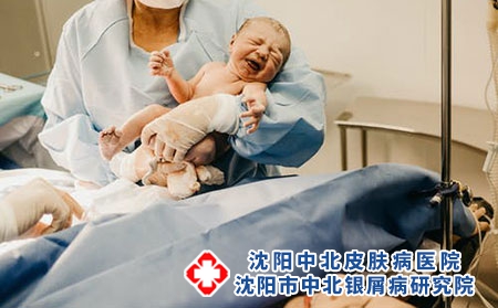 新生儿牛皮癣治疗方法有哪些?