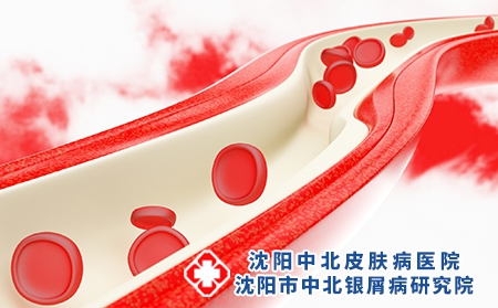 银屑病出血多久能好？