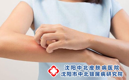 年轻人牛皮癣发病机理