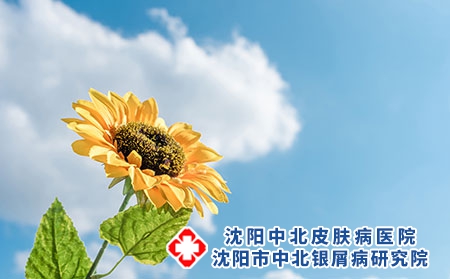 牛皮癣患者多晒太阳好吗?