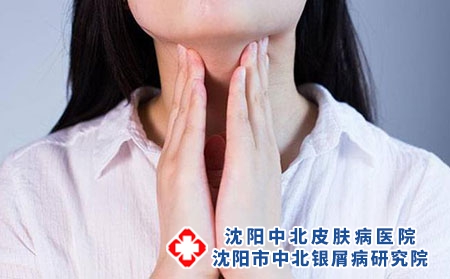 咽炎是不是牛皮癣的诱因呢