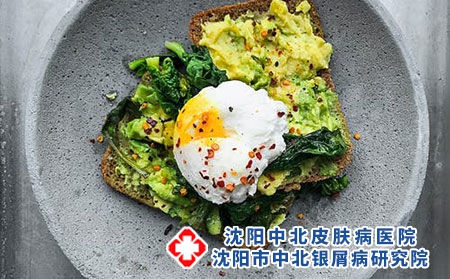 牛皮癣的饮食禁忌有哪些呢?