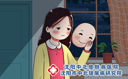 治疗牛皮癣的生活妙招?