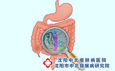 牛皮癣治疗重在排五脏之毒