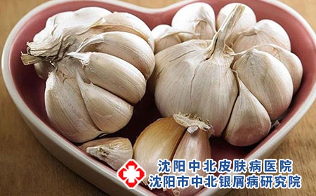 大蒜和韭菜治牛皮癣吗？