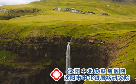 脓包型的牛皮癣的主要症状