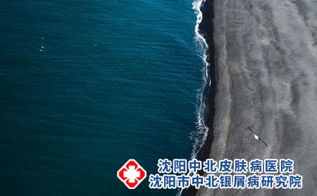 泡温泉能治愈牛皮癣吗-介绍几个特效偏方