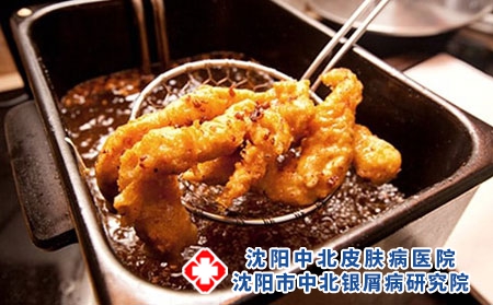 牛皮癣可以吃过于油腻的食物吗-牛皮癣不能吃什么食物？