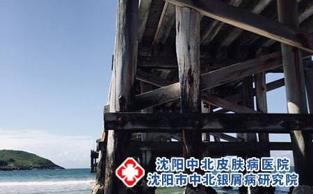 牛皮癣能治疗吗-这些方法可治牛皮癣