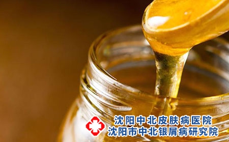 对牛皮癣病情缓解有利的食物有哪些？