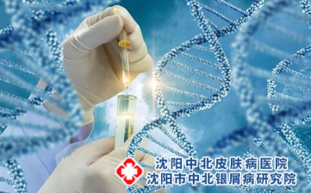 牛皮癣治疗安全为首-牛皮癣要注意治疗方法