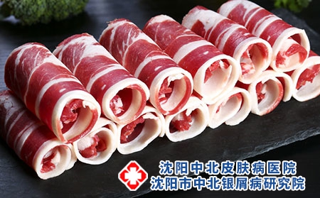 牛皮癣吃羊肉可以吗-患者吃羊肉会加重病情