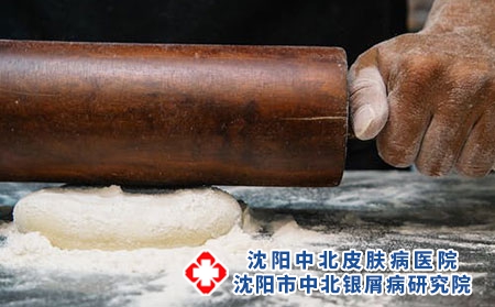 可减少牛皮癣患者皮肤鳞屑的食疗方有哪些 食疗效果也不错