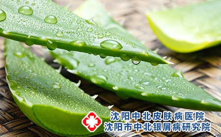芦荟对治疗头部牛皮癣会有帮助吗 头部牛皮癣洗头发要注意什么好
