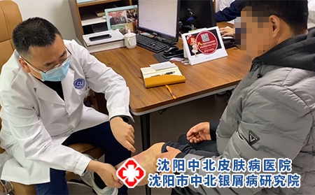 沈阳哪家治银屑病-沈阳市中北银屑病研究院-沈阳在哪治疗银屑病