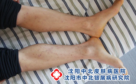 老年银屑病患者可以手术治疗吗?