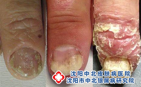 指甲牛皮癣2 指甲牛皮癣2