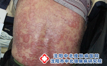 银屑病能吃人参吗？营养师：这类食物更适合，必看