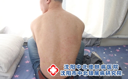 银屑病早期症状大全，别忽视！出现这些情况要及时就医