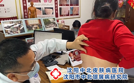 沈阳哪专治银屑病-沈阳中北银屑病研究院-沈阳治银屑病到哪好