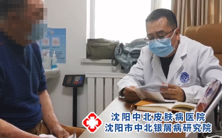 沈阳中北医院治牛皮癣好吗 - 沈阳中北医院