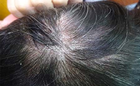 分享头部患上银屑病有可能导致脱发吗图片