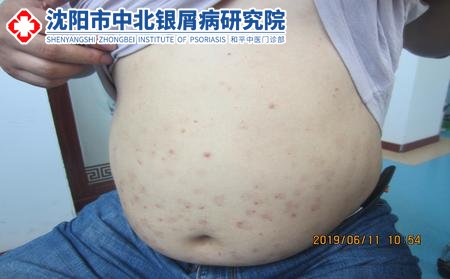 沈阳较好的牛皮癣医院在哪