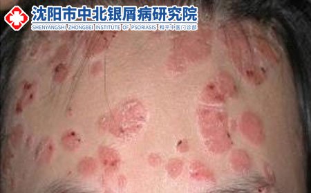 银屑病图片_沈阳中北银屑病研究院好不好_沈阳中北研究院好不好_沈阳银屑病医院好不好