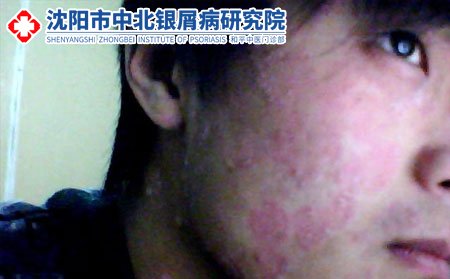 面部牛皮癣症状