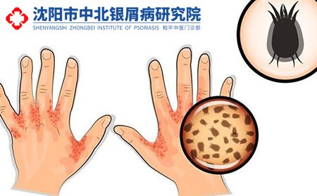 沈阳专业治疗银屑病医院收费高不