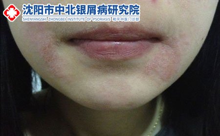 沈阳中北银屑病研究院网上咨询